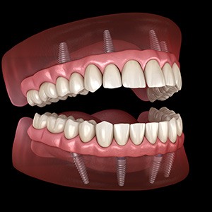 a digital design showing how implant dentures work