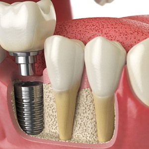 An illustration of an implant receiving its dental crown