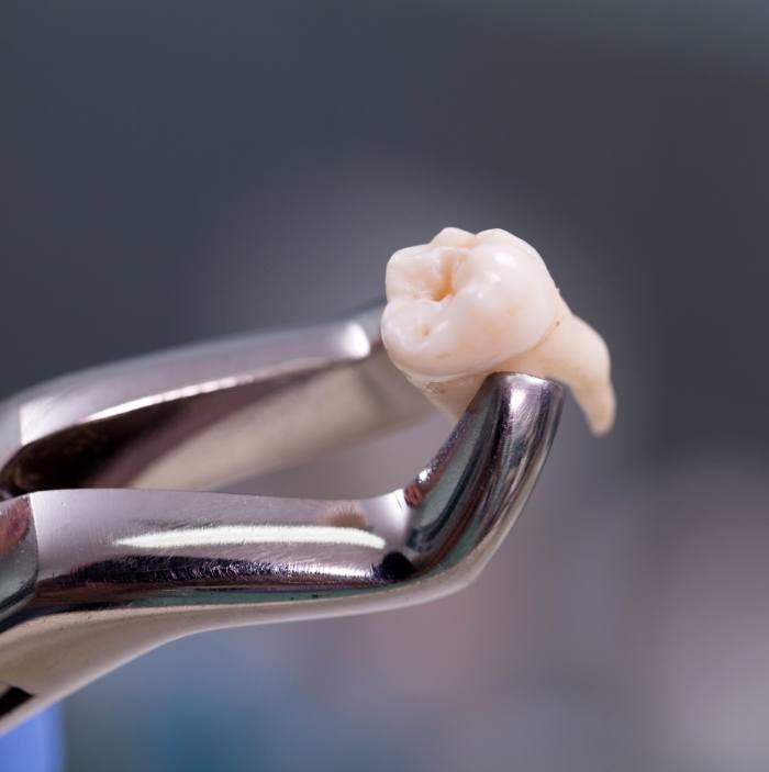 Tooth in dental forceps after tooth extractions in Scottsdale